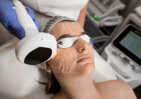 Terapia Rumienia laserem IPL